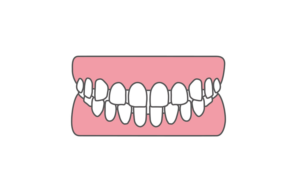 空隙歯列（すきっ歯）