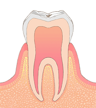 C0 初期の虫歯