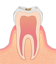 C1 エナメル質の虫歯