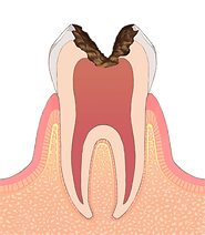C3 神経まで侵された虫歯