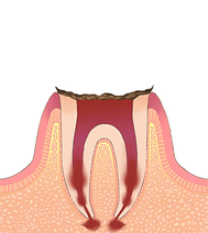 C4 歯の根まで達した虫歯