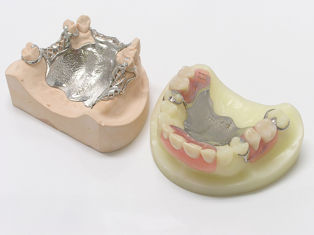 金属床（自費治療）